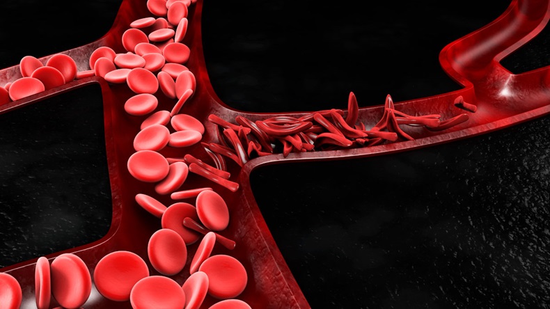 Anemia, sickle cell and normal red blood cell, 3d Illustration.