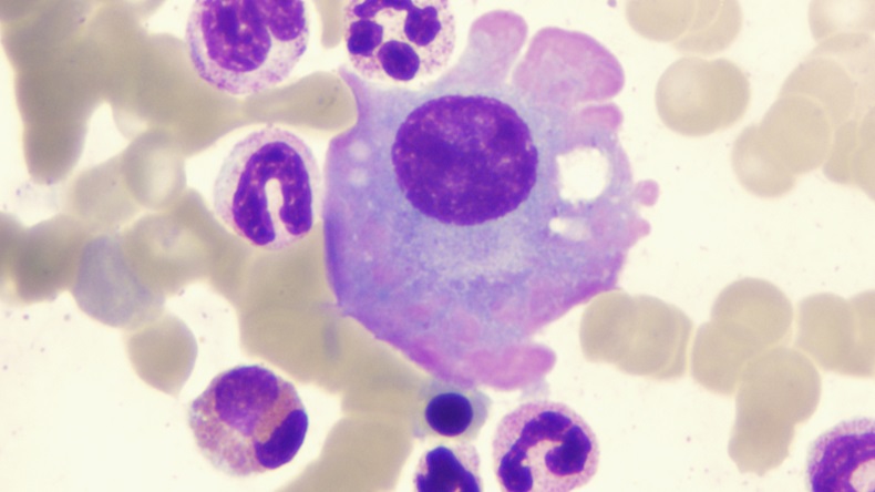Multiple myeloma (showing flame-shaped plasma cell) - Image 