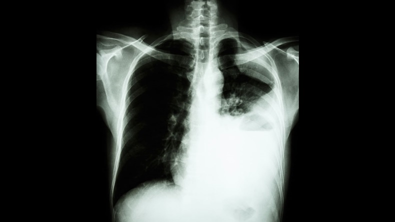 Lung cancer ( film x-ray of chest PA upright : show pleural effusion at left lung due to lung cancer ) ( 2 type of lung cancer : Non-small cell lung cancer , Small cell carcinoma )