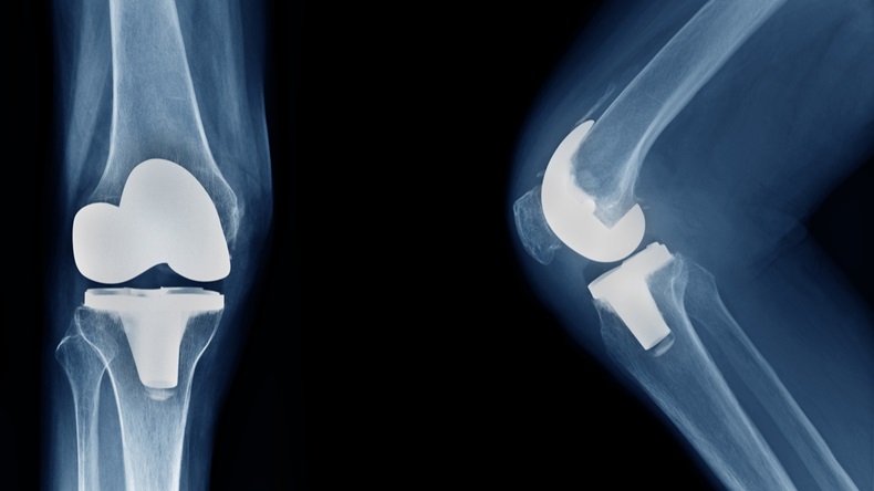 Knee replacement X-ray