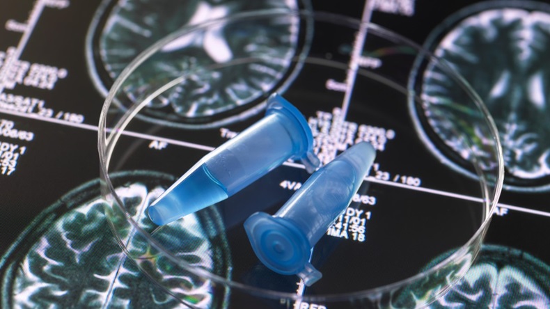 Alzheimer's brain scan and drugs