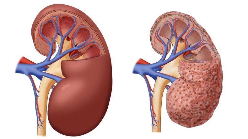 healthy and chronic kidney diseased kidney 