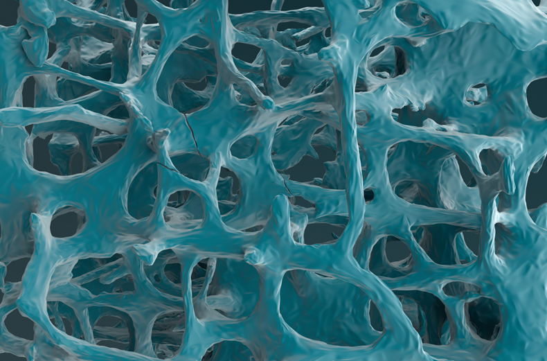 Fracture bones in osteoporosis - front view 3d illustration