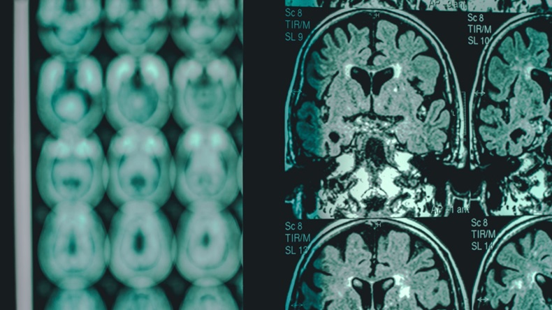 Alzheimers brain images