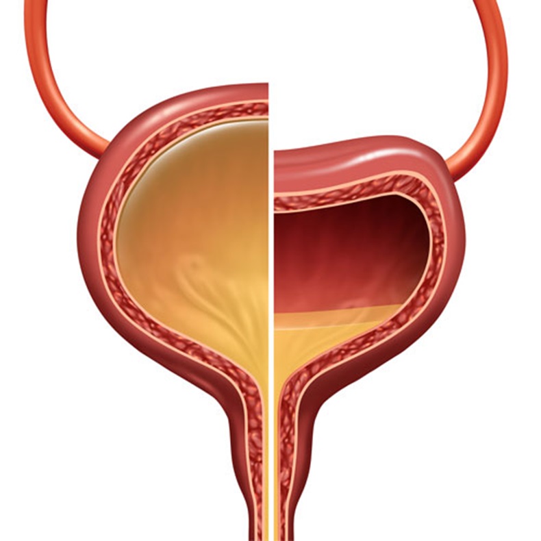Bladder as a normal and overactive urinary organ comparison representing the involuntary loss of urine concept as a healthy and unhealthy condition with 3D illustration elements.