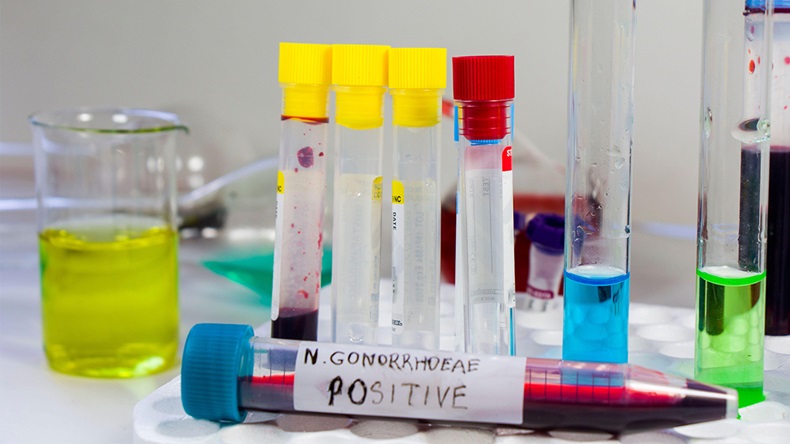 Gonorrhea blood test tube positive sample. Alamy - 2CCG4AH