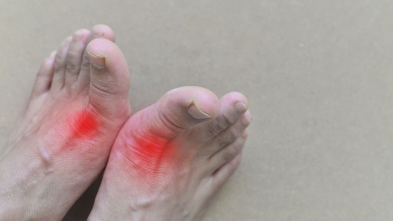Foot of gout patient.Close up Painful and inflamed gout. - Image 