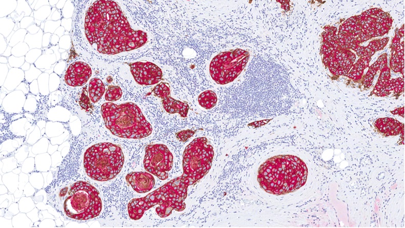 Cancer of the breast stained for HER-2 and cytokeratin 